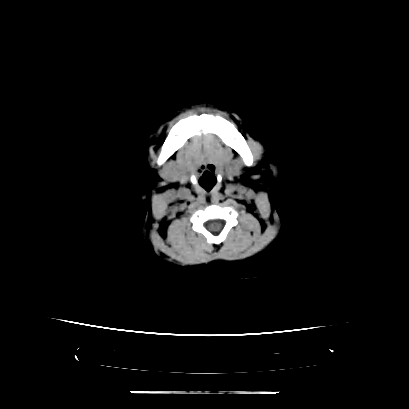 Cloverleaf skull (Radiopaedia 91901-109710 Axial non-contrast 24).jpg