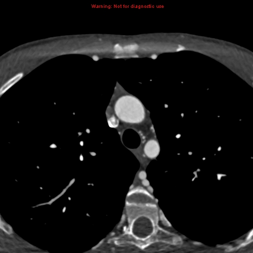 File:Coarctation of the aorta (Radiopaedia 12461-12697 A 82).jpg