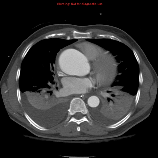 File:Coarctation of the aorta (Radiopaedia 8681-9490 B 37).jpg