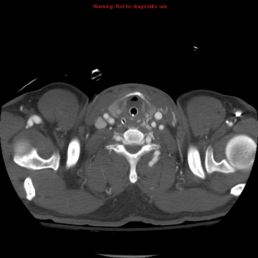 File:Coarctation of the aorta (Radiopaedia 8681-9490 B 4).jpg
