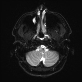 Cochlear incomplete partition type III associated with hypothalamic hamartoma (Radiopaedia 88756-105498 Axial DWI 5).jpg