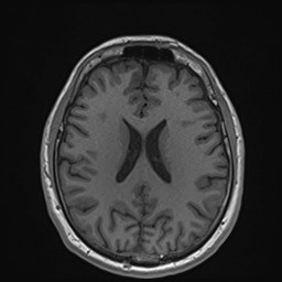 File:Cochlear incomplete partition type III associated with hypothalamic hamartoma (Radiopaedia 88756-105498 Axial T1 123).jpg
