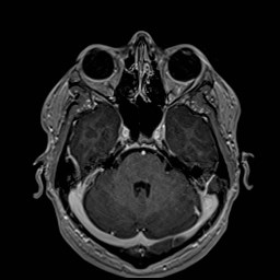 File:Cochlear incomplete partition type III associated with hypothalamic hamartoma (Radiopaedia 88756-105498 Axial T1 C+ 68).jpg