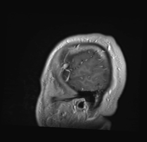 Cochlear incomplete partition type III associated with hypothalamic hamartoma (Radiopaedia 88756-105498 Sagittal T1 C+ 49).jpg