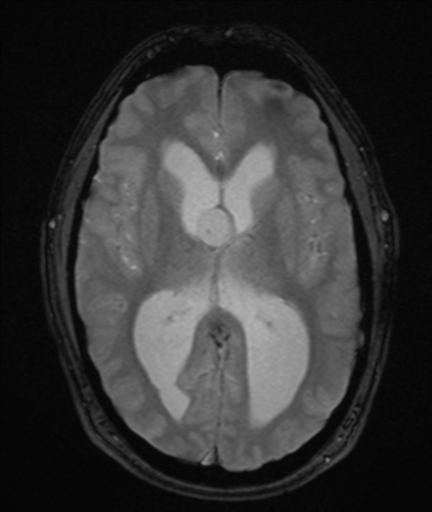 File:Colloid cyst (Radiopaedia 44510-48181 Axial Gradient Echo 14).png