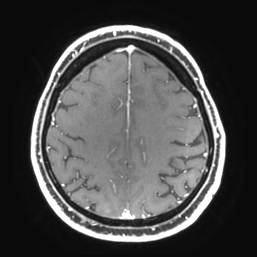 File:Colloid cyst (large) (Radiopaedia 34415-35729 Axial T1 C+ 25).png