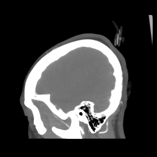 File:Colloid cyst (resulting in death) (Radiopaedia 33423-34499 B 9).png