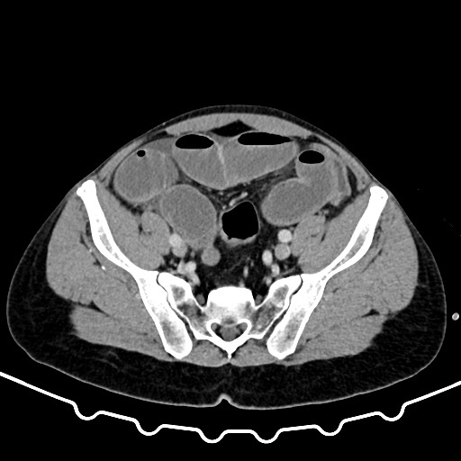 Colocolic intussusception due to large lipoma (Radiopaedia 68773-78482 A 150).jpg