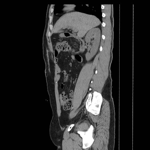 File:Colocutaneous fistula in Crohn's disease (Radiopaedia 29586-30093 C 11).jpg