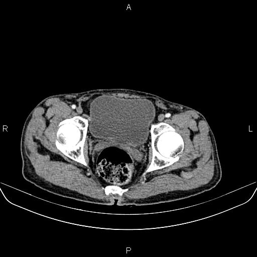 Colon adenocarcinoma - hepatic flexure (Radiopaedia 85635-101395 A 90).jpg