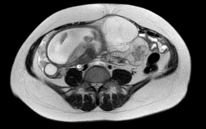 Colon adenocarcinoma with Krukenberg tumors, advanced pregnancy (Radiopaedia 67279-76645 Axial T2 32).jpg