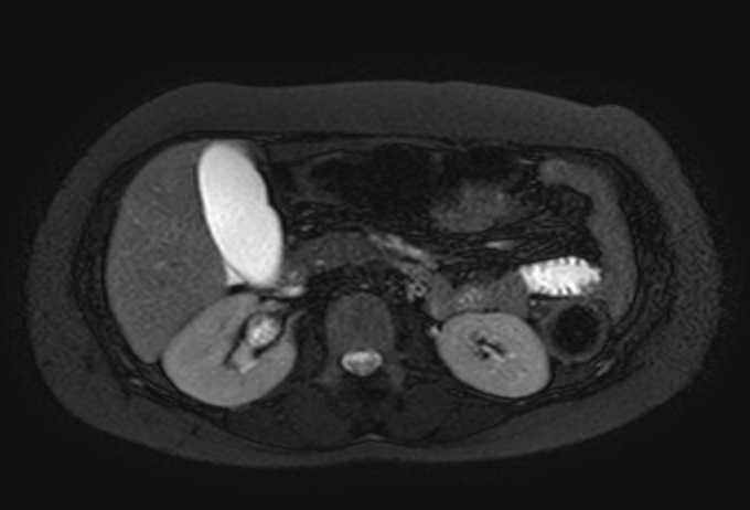 Colon adenocarcinoma with Krukenberg tumors, advanced pregnancy (Radiopaedia 67279-76645 Axial T2 SPAIR 52).jpg