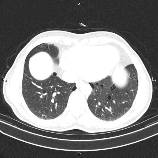 File:Colon cancer (Radiopaedia 85663-101443 Axial lung window 47).jpg