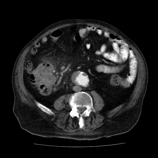 File:Colon cancer with duodenal invasion (Radiopaedia 16278-15958 A 36).jpg