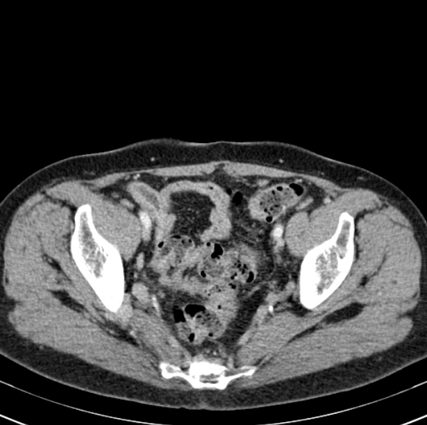 Colon carcinoma with hepatic metastases (Radiopaedia 29477-29961 A 98).jpg