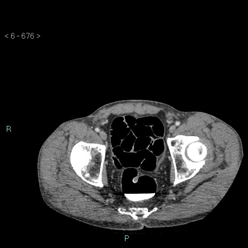 File:Colonic cancer (ultrasound and TC imaging) (Radiopaedia 50346-55713 A 130).jpg