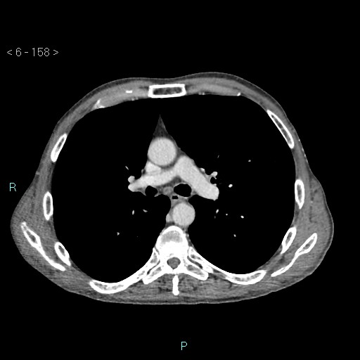 Colonic cancer (ultrasound and TC imaging) (Radiopaedia 50346-55713 B 158).jpg