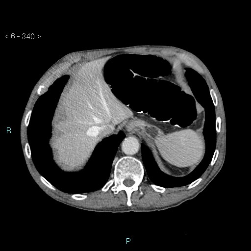 Colonic cancer (ultrasound and TC imaging) (Radiopaedia 50346-55713 B 340).jpg