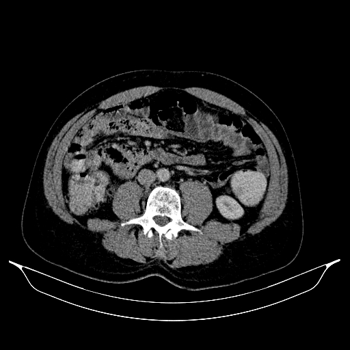 Colonic diverticulosis (Radiopaedia 72222-82744 A 34).jpg