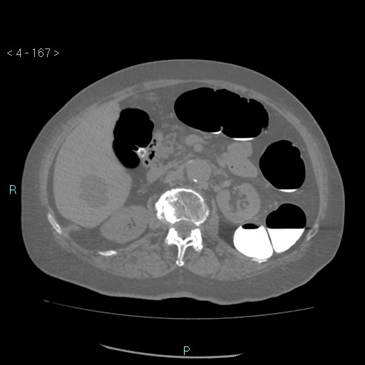 File:Colonic lipomas (Radiopaedia 49137-54244 Axial bone window 75).jpg