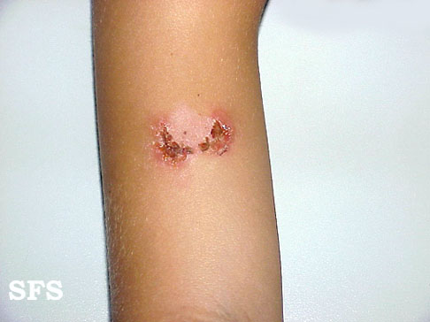File:Impetigo (Dermatology Atlas 9).jpg