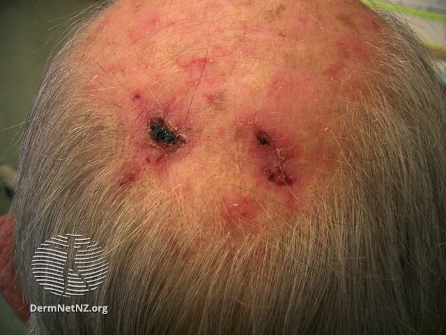 Intraepidermal carcinoma (DermNet NZ lesions-scc-in-situ-2924).jpg