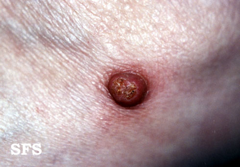 File:Keratoacanthoma (Dermatology Atlas 4).jpg