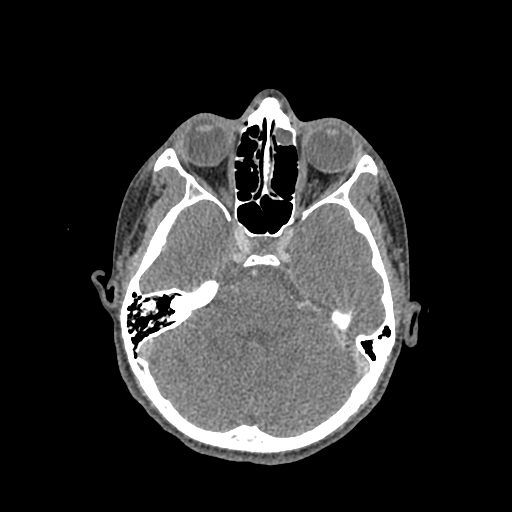 File:Nasal pyogenic granuloma (lobular capillary hemangioma) (Radiopaedia 85536-101244 C 100).jpg