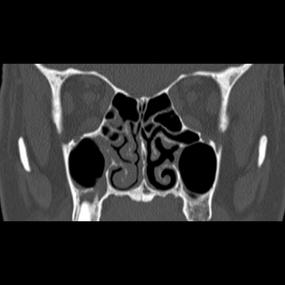 File:Nasal septal perforation (Radiopaedia 25030-25289 Coronal bone window 38).jpg