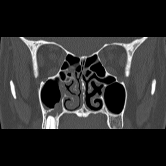 Nasal septal perforation (Radiopaedia 25030-25289 Coronal bone window 39).jpg