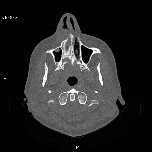 Nasolabial cyst (Radiopaedia 75125-86194 Axial bone window 48).jpg