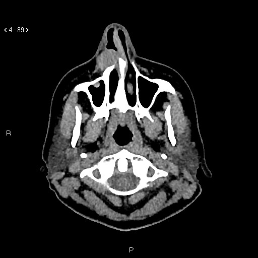 Nasolabial cyst (Radiopaedia 75125-86194 Axial non-contrast 51).jpg