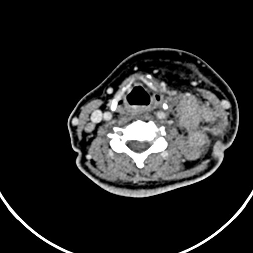 Nasopharyngeal carcinoma- T4,N3b (Radiopaedia 59376-66738 B 80).jpg