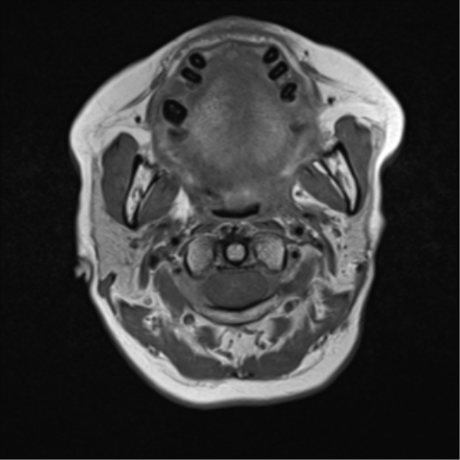 File:Nasopharyngeal carcinoma with cerebral abscess (Radiopaedia 43018-46273 Axial T1 24).png