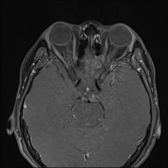 Nasopharyngeal carcinoma with skull base invasion (Radiopaedia 53415-59485 Axial T1 C+ fat sat 15).jpg