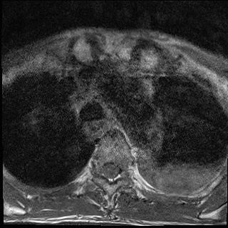 File:Nasopharyngeal carcinoma with skull base invasion (Radiopaedia 59258-66600 Axial T1 33).jpg