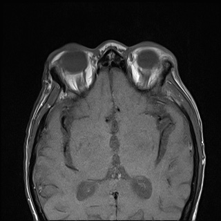 Nasopharyngeal carcinoma with skull base invasion (Radiopaedia 59258-66600 B 2).jpg