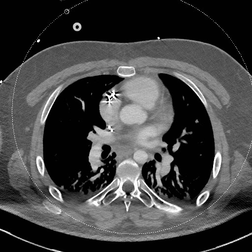 Neck CT angiogram (intraosseous vascular access) (Radiopaedia 55481-61945 B 10).jpg