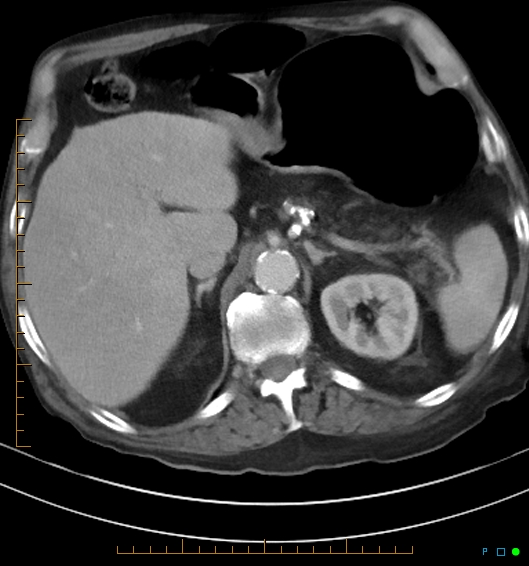 Necrotzing fasciitis due to a perforated adenocarcinoma of the splenic flexure (Radiopaedia 46930-51455 A 22).jpg