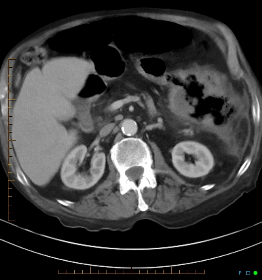 Necrotzing fasciitis due to a perforated adenocarcinoma of the splenic flexure (Radiopaedia 46930-51455 A 28).jpg