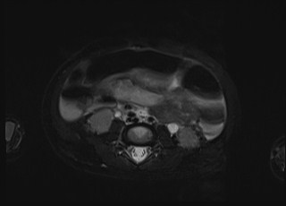 Neonatal prostatic utricle abscess - cyst (Radiopaedia 69511-79394 Axial T2 fat sat 38).jpg