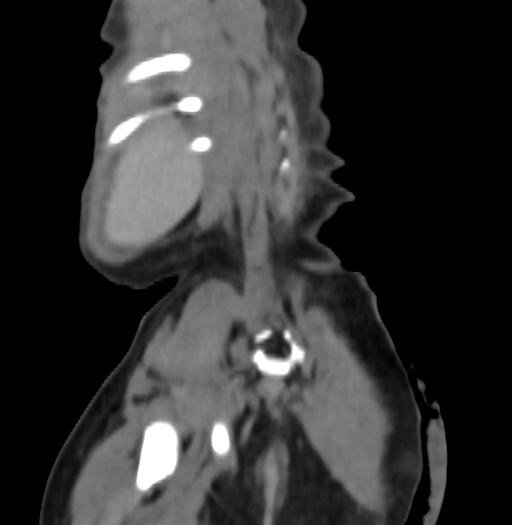 Nephroblastomatosis (Radiopaedia 71294-81607 B 286).jpg