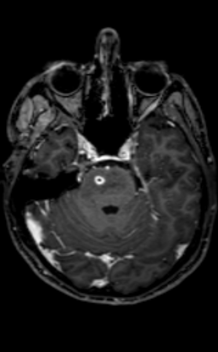 Neuro-Behçet disease (Radiopaedia 90112-107294 Axial T1 C+ 160).jpg