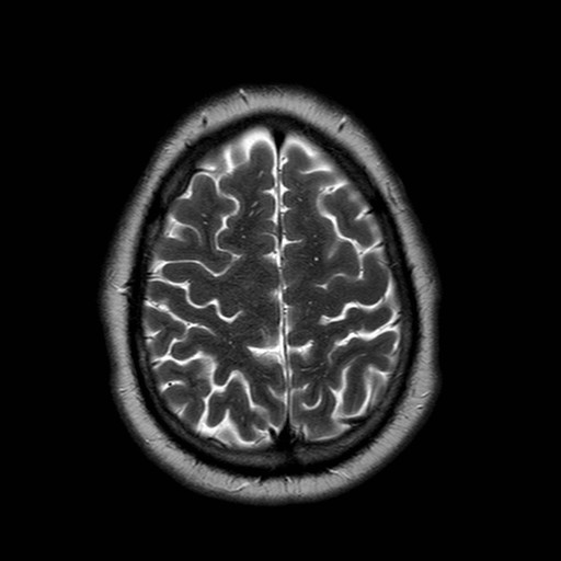 File:Neuro-Behcet's disease (Radiopaedia 21557-21506 Axial T2 23).jpg