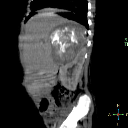 File:Neuroblastoma (Radiopaedia 24751-25016 C 22).jpg