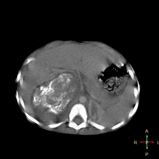 File:Neuroblastoma (Radiopaedia 24751-25016 D 10).jpg