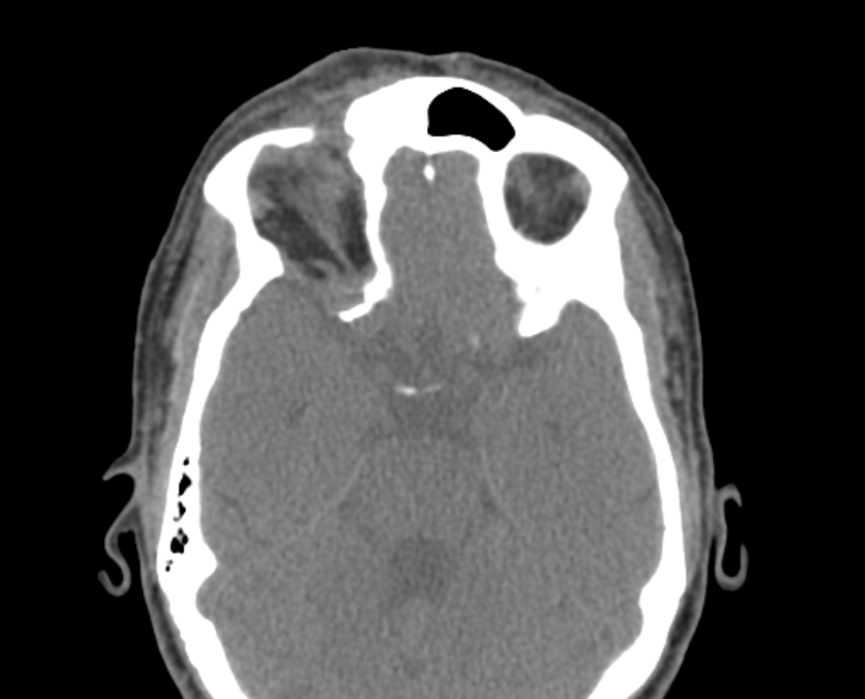 Neurofibromatosis type 1- orbital manifestations (Radiopaedia 49391-54511 Axial non-contrast 59).jpg