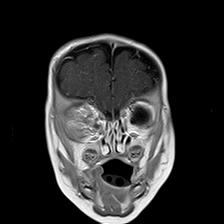 File:Neurofibromatosis type 1 (Radiopaedia 30089-30671 Coronal T1 C+ 6).jpg