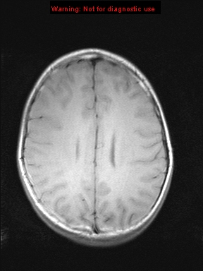 File:Neurofibromatosis type 1 with optic nerve glioma (Radiopaedia 16288-15965 Axial T1 8).jpg