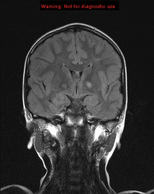 File:Neurofibromatosis type 1 with optic nerve glioma (Radiopaedia 16288-15965 Coronal FLAIR 14).jpg